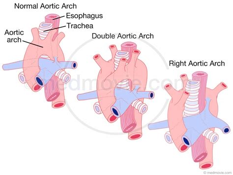 Aortic Arch Malformations – Medmovie.com