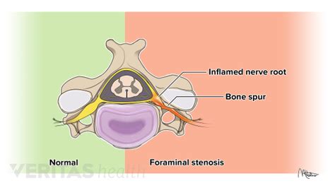 Cervical Radiculopathy Causes And Risk Factors Artofit