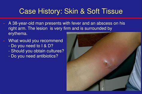 Ppt Skin And Soft Tissue Infections Powerpoint Presentation Free