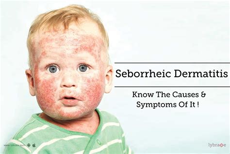 Seborrheic Dermatitis Know The Causes Symptoms Of It By Dr 10788 Hot