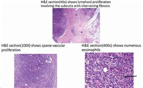 Histopathology Examination Of Incisional Biopsy Specimen Download