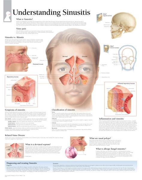 understanding sinusitis scientific publishing