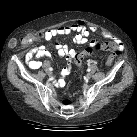 Hernia 0501 Spigelian Hernia Rlq | Surgery Photos