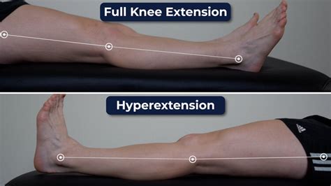 Improving Knee Extension Range Of Motion E3 Rehab