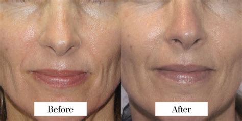 Rf Microneedling Brisbane Jade Cosmetic Clinic