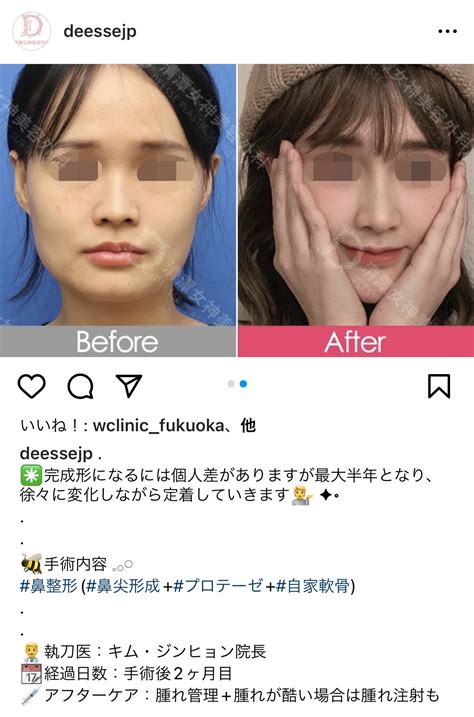 100日後に可愛くなる🏥みさちゃす💄 On Twitter 私は病院と執刀医を信用している。鼻の皮膚が厚いせいで鼻先が腫れているが、その