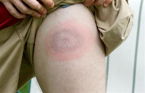 Lyme Disease Rash Name At Valerie Saunders Blog