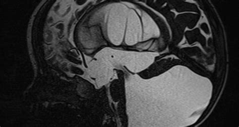 Dandy Walker Syndrome - Neuropedia