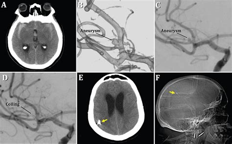 Early Distal Coil Migration Requiring Surgical Treatment