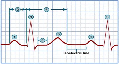 Dysrhythmias Week Diagram Quizlet