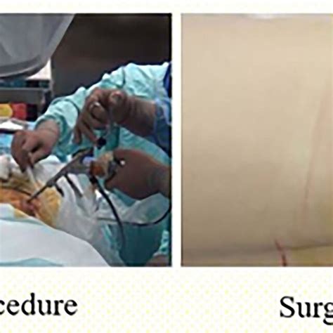 Operative Scene In Percutaneous Transforaminal Endoscopic Discectomy