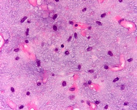 Pathology Outlines Myxoid Liposarcoma