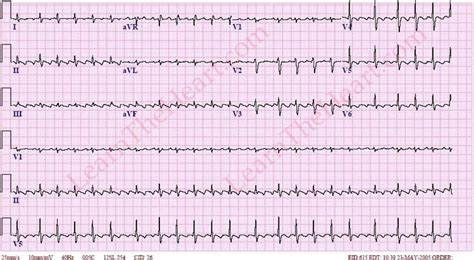 Atrial Flutter With Variable Conduction ECG Example 3 Learn The Heart