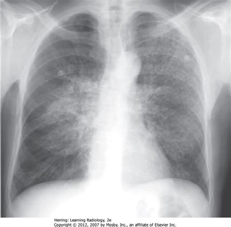 Pneumocystis Pneumonia Flashcards Quizlet