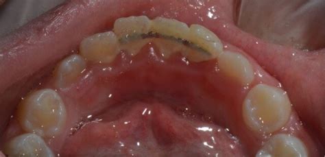 Lingual View Showing The Retainer In Place Some Plaque Accumulation