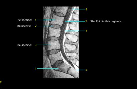 Abdomen Lumbar Spine MRI Sagittal View 6 Diagram Quizlet