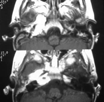 Rhabdomyosarcoma