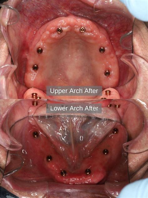 Upper And Lower Implant Retained Overdentures Before After Photos