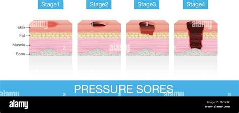 Stages of Pressure Sores Stock Vector Image & Art - Alamy