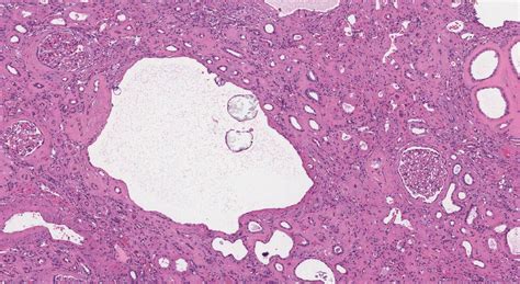 Polycystic kidney disease | Ottawa Atlas of Pathology