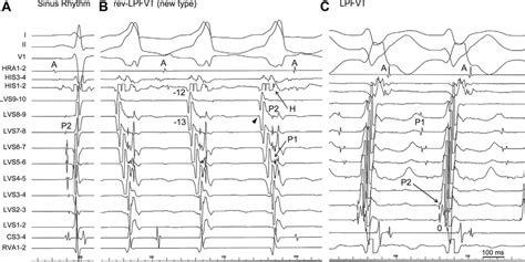 Patient Left Septal Mapping During Sinus Rhythm Reverse Type Lpfvt