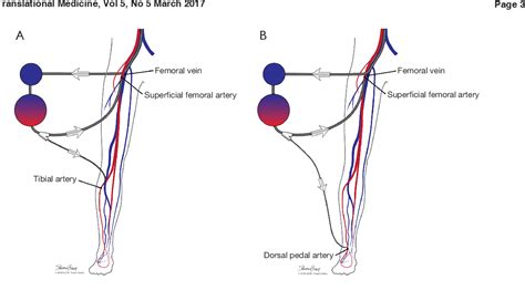 Figure 2 from Use of distal perfusion in peripheral extracorporeal ...