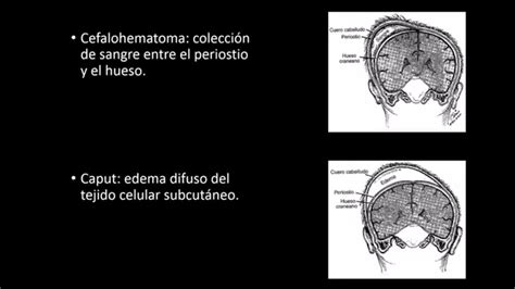 Cefalohematoma Vs Caput Succedaneum Youtube