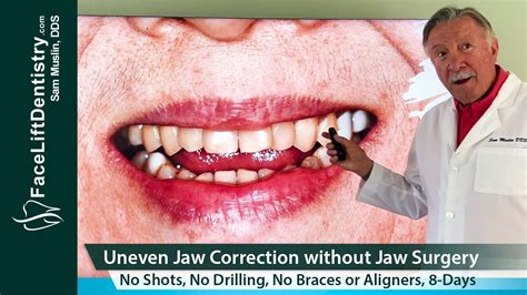 Video: Non-Surgical Solution for Uneven Jaws and Jaw Pain