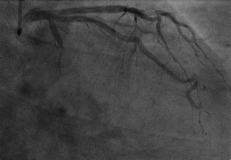 Coronary angiography revealed occlusion of left circumflex coronary ...