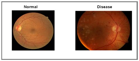 Mild Hypertensive Retinopathy