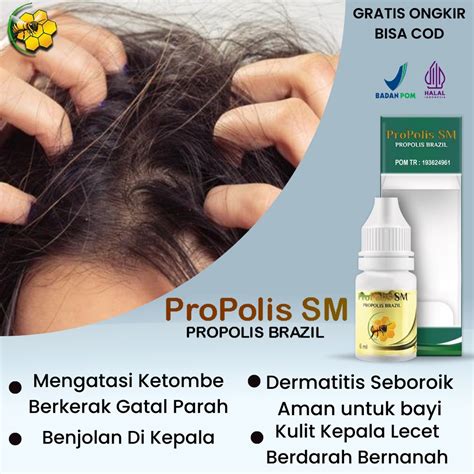 Jual Obat Tetes Psoriasis Kulit Kepala Borok Dermatitis Seboroik