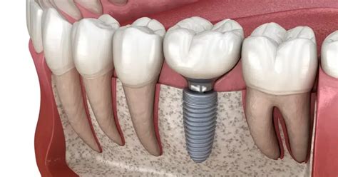 Quanto Costano Gli Impianti Dentali In Albania Virtus Dental Center