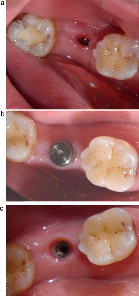 Efficacy And Safety Of A Diode Laser In Second Stage Implant Surgery A