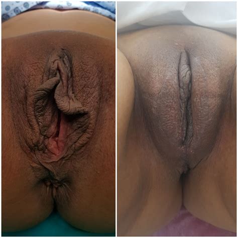 Vaginoplasty Before And After Photos Op Dr Cem Zl K