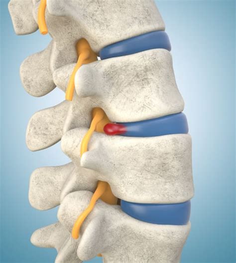 Slipped Disc Treatment at Spine One | Denver Spine Pain Specialists