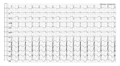 Ecg Immediately After Defibrillation Showed Sinus Tachycardia With A