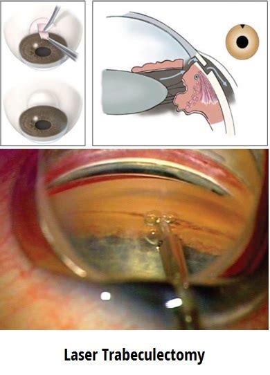 Laser Trabeculectomy