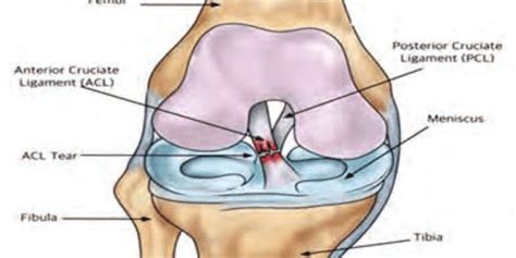 Anterior Cruciate Ligament Injury Can Be Fully Managed With Surgery