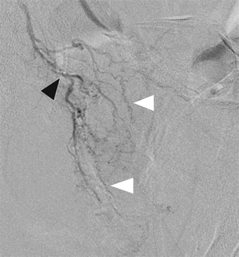 Superselective Digital Subtraction Angiogram In The Same Patient In