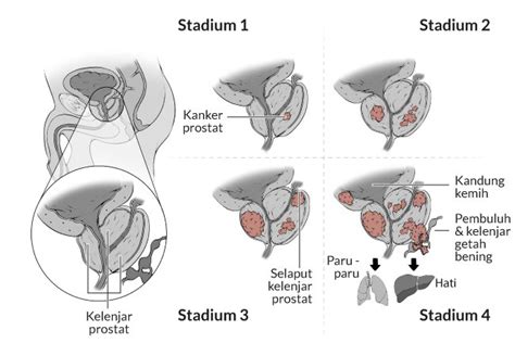 Gejala Kanker Prostat Alodokter