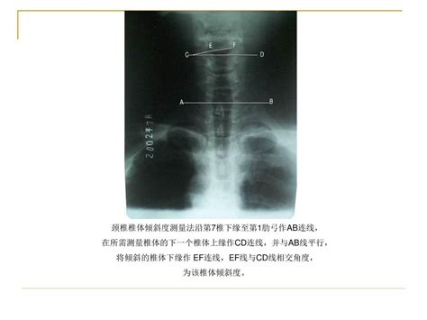 颈椎x线诊断 平高医院康复科 赵铎 Ppt Download