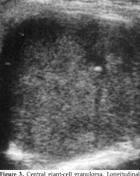 Figure 3 From Unexpected Diagnosis For Preauricular Swelling Two Case