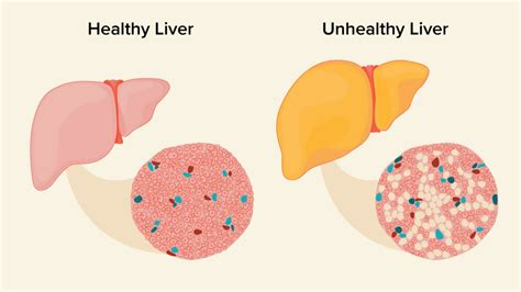 Naturopathic Tips To Address Fatty Liver Disease Thedailyguardian