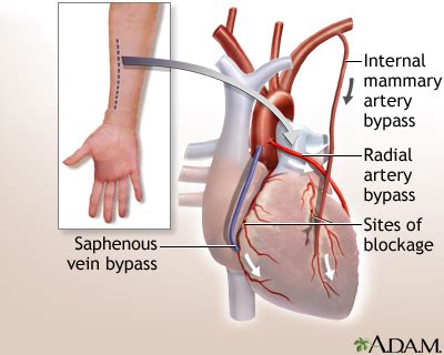 Heart Bypass Surgery Minimally Invasive Multimedia Encyclopedia