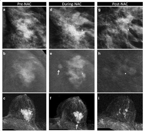 Partial Response In Invasive Ductal Carcinoma Idc And Ductal