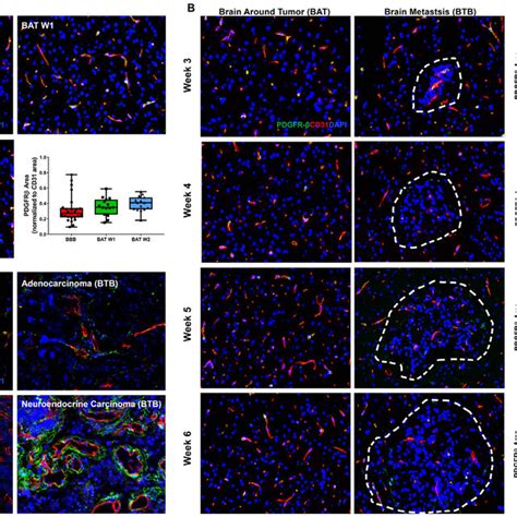 Loss Of Pdgfr Protein Expression In Nsclc Brain Metastases