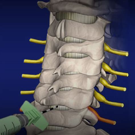 Cervical Epidural Steroid Injections Segura Pain Center