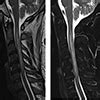 Sarcoidosis Presenting As Longitudinally Extensive Transverse Myelitis