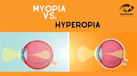 All About Myopia Vs Hyperopia [ August 2024 ]