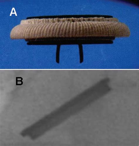 Figure 3 from Intermittent acute aortic regurgitation of a mechanical ...